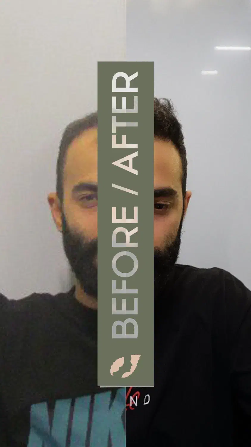 کاشت مو و ابرو|خدمات آرایشگری و زیبایی|تهران, جردن|دیوار