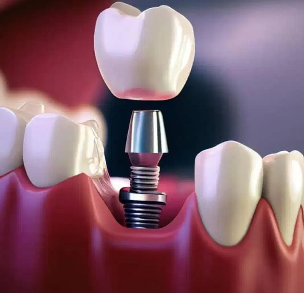 جشنواره ایمپلنت دیجیتال در شیراز|خدمات آرایشگری و زیبایی|جهرم, |دیوار