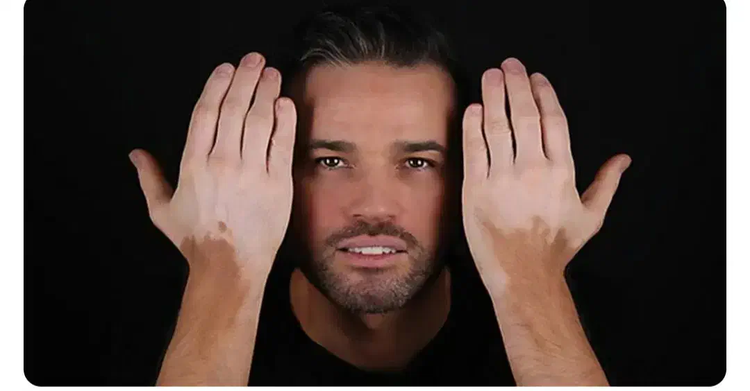 پیسی وویتیلیگو|آرایشی، بهداشتی، درمانی|تیکمه داش, |دیوار