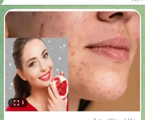 پوستی زیبا وشفاف|فعالیت داوطلبانه|اهواز, اهواز|دیوار