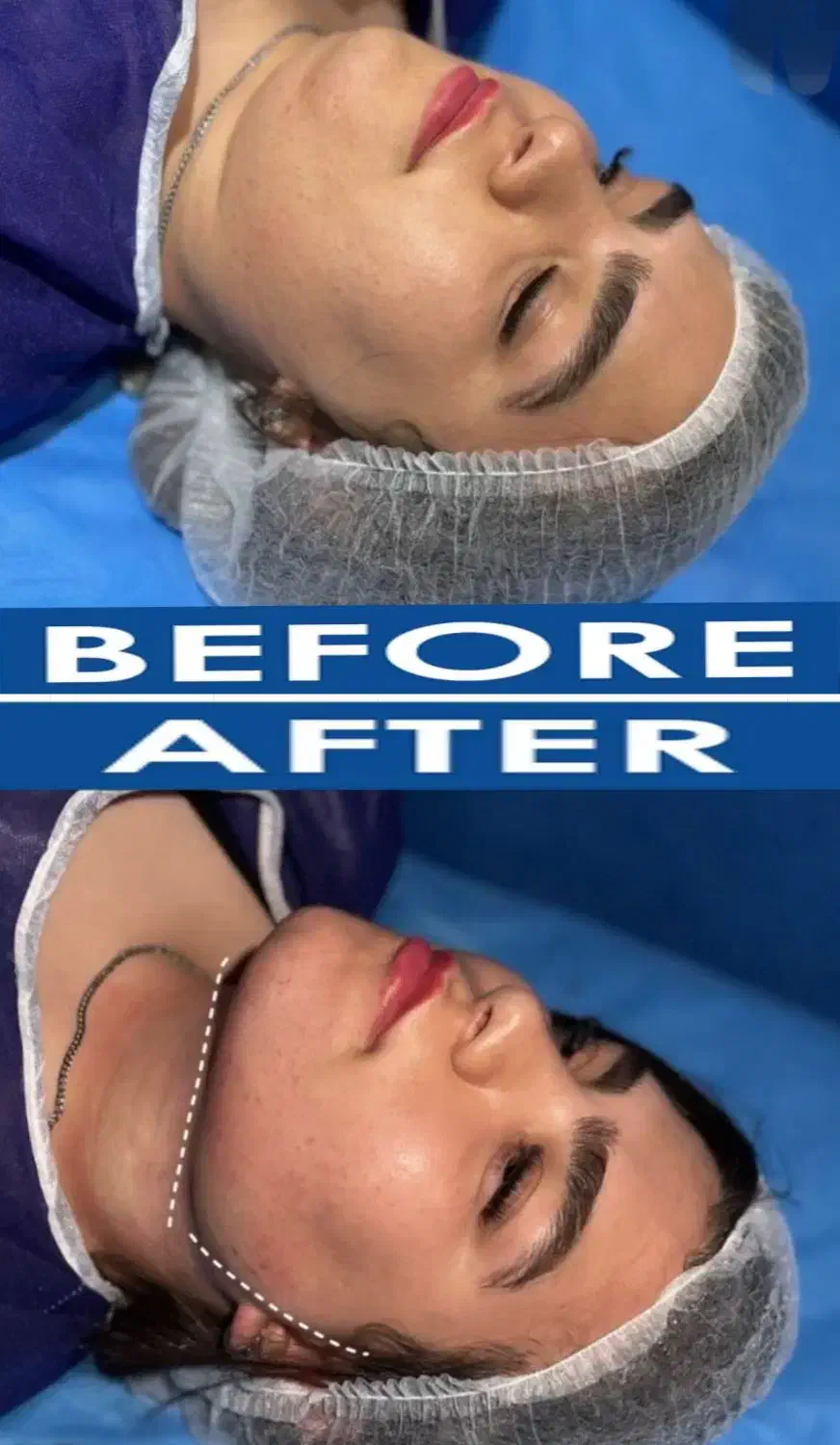 جشنواره ساکشن شکم ، پهلو و غبعب|خدمات آرایشگری و زیبایی|کرمانشاه, |دیوار