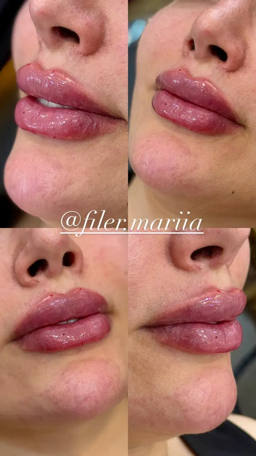 تزریق فیلر صورت مطابق المانهای زیبایی شناسی|خدمات آرایشگری و زیبایی|قرچک, پویینک|دیوار