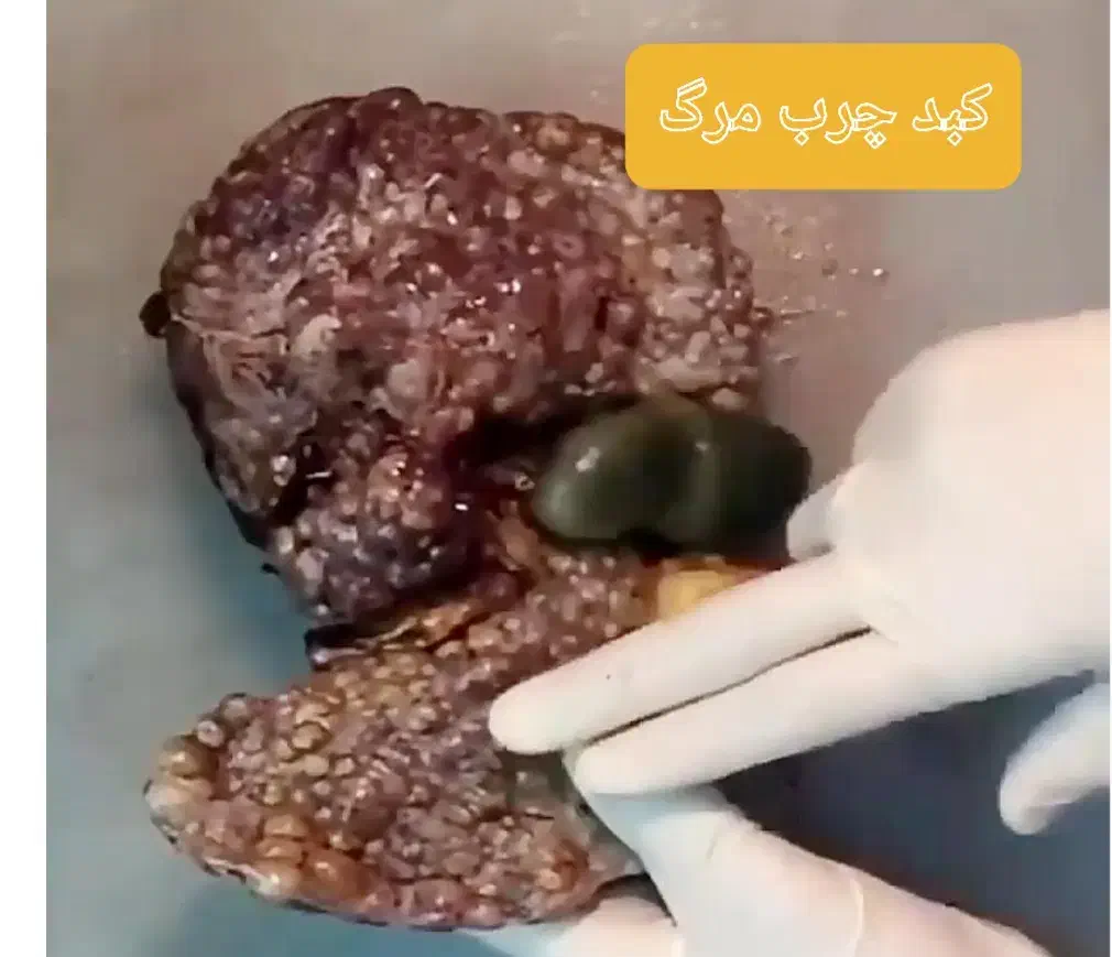 بهبودی کامل کبد چرب کمتر از یک دوره|خدمات آرایشگری و زیبایی|گنبد کاووس, |دیوار