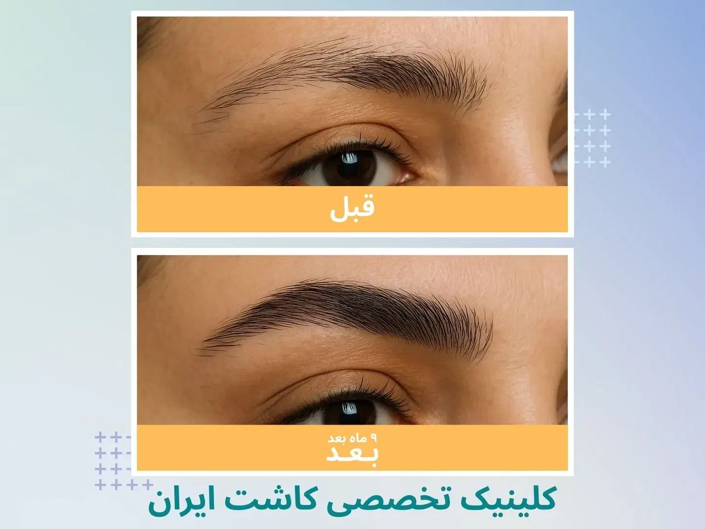 کاشت مو/ فول تراکم/ متد FIT/ بدون نیاز به جراحی|خدمات آرایشگری و زیبایی|تهران, دروس|دیوار