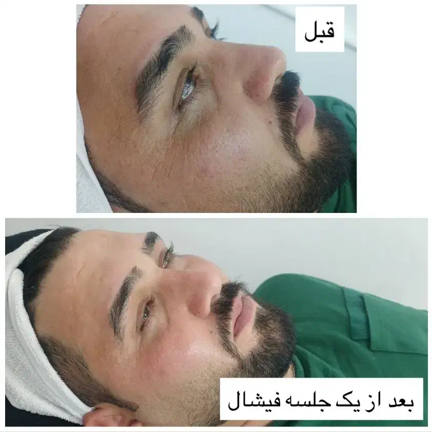 پاکسازی درمانی و تخصصی پوست برا خانم ها و آقایان|خدمات آرایشگری و زیبایی|کاشان, زیدی|دیوار