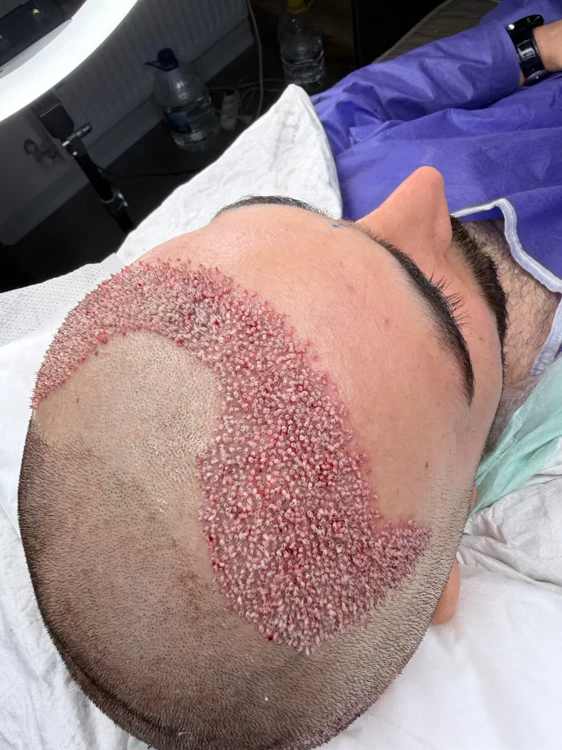 کاشت مو ی پر تراکم|خدمات آرایشگری و زیبایی|ساری, |دیوار