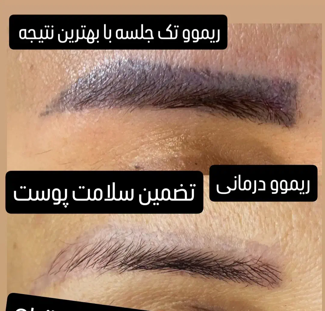 ریموو و پاک کردن تضمینی تتوی ابرو و چشم شما|خدمات آرایشگری و زیبایی|ایلام, |دیوار