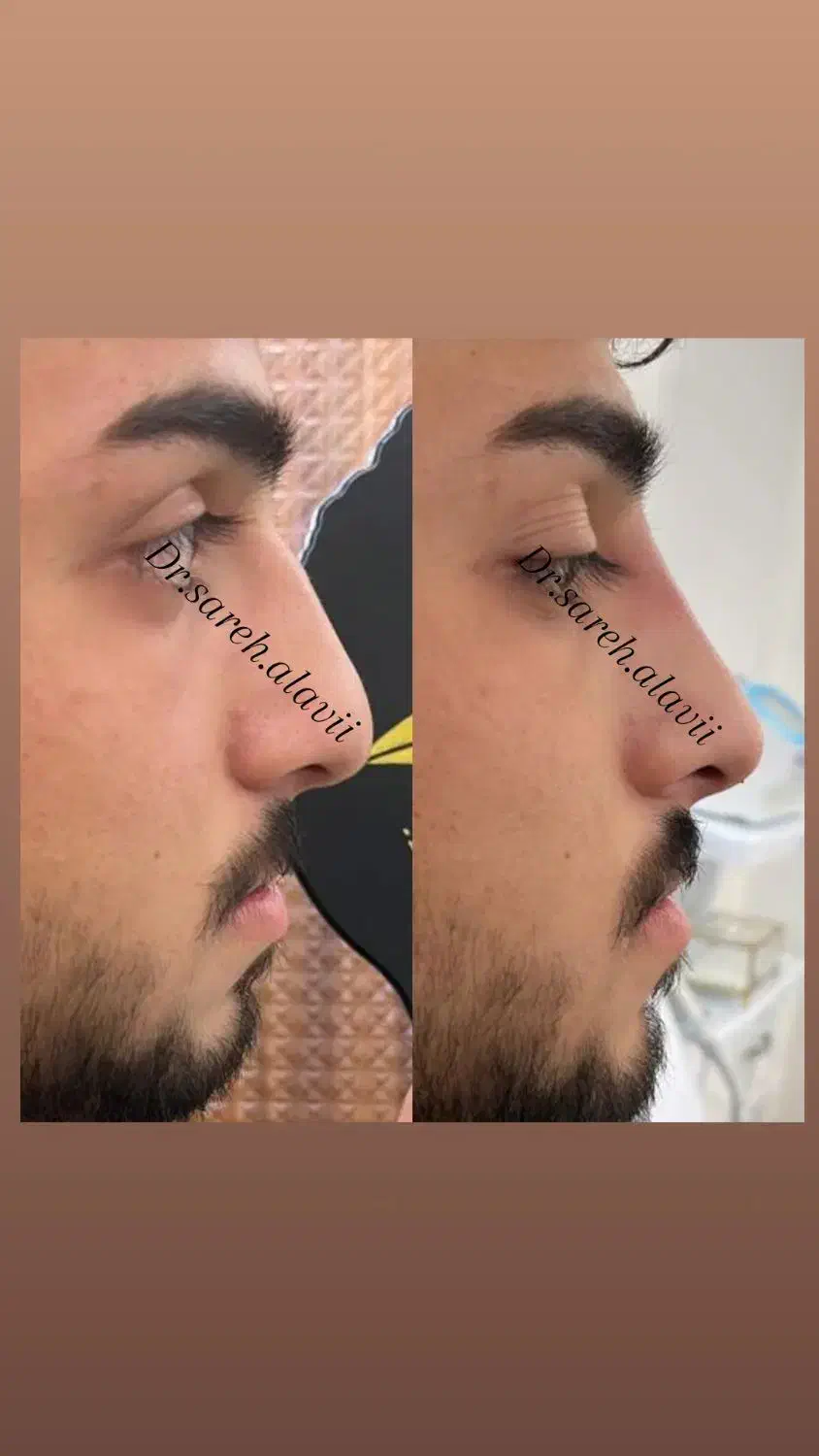 اصلاح فرم و کوچک کردن بینی توسط پزشک بدون جراحی|خدمات آرایشگری و زیبایی|قم, دورشهر|دیوار
