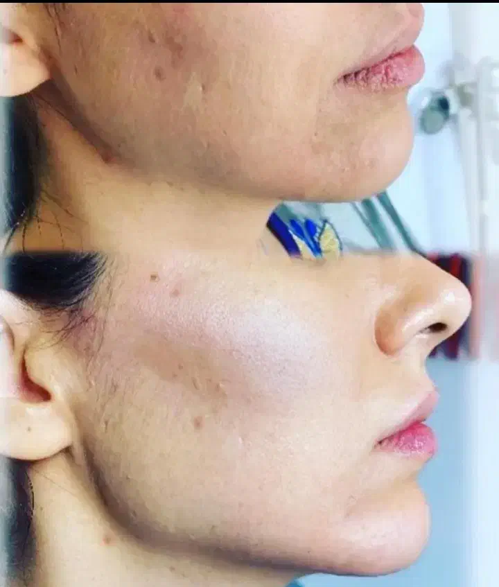 ، تزریق ژل فیلر بوتاکس مزو فیلر بادی..|خدمات آرایشگری و زیبایی|شیراز, فضل‌آباد|دیوار