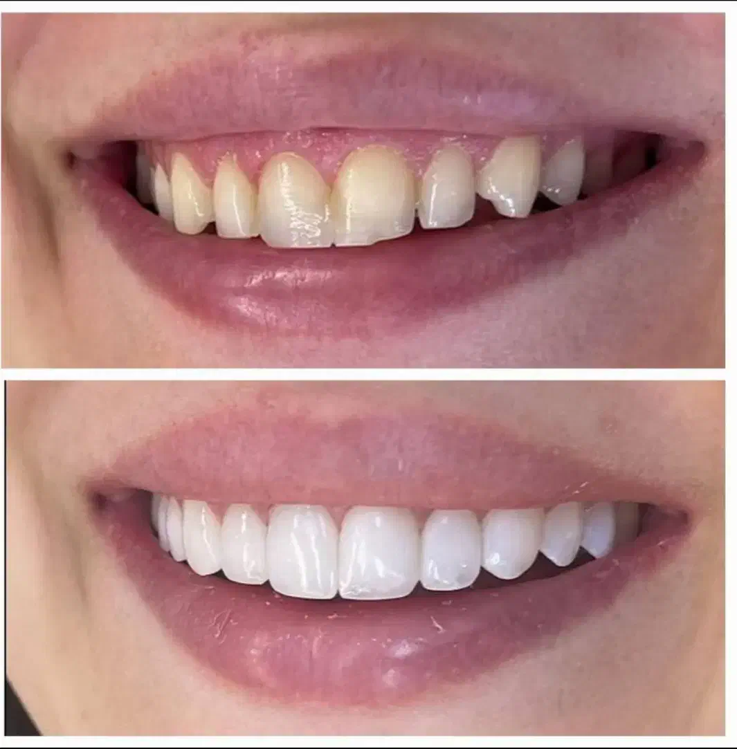 جشنواره کامپوزیت دندان از واحدی 800تومن شروع قیمت|خدمات آرایشگری و زیبایی|صفادشت, |دیوار