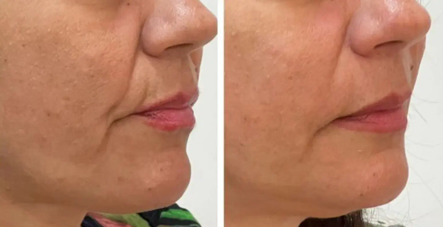 تزریق چربی جوانساز|خدمات آرایشگری و زیبایی|رفسنجان, |دیوار