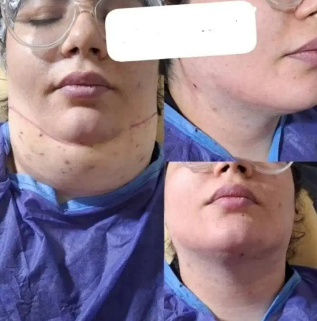 لیپوساکشن چربی جراحی بلفارو لیفت نخ ژل|خدمات آرایشگری و زیبایی|کوهدشت, |دیوار