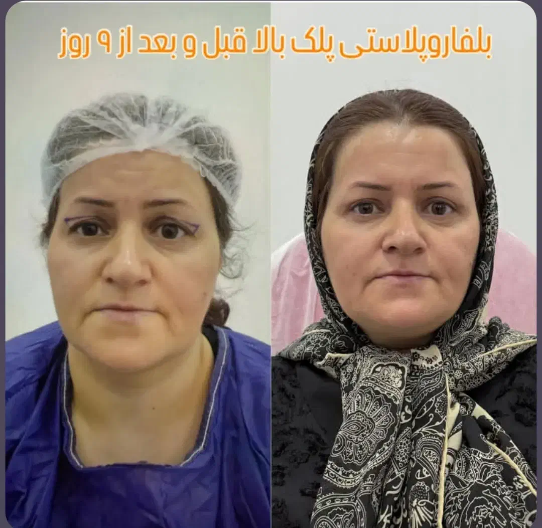 بلفاروپلاستی پلک بالا به مدت محدود فقط 8 میلیون|خدمات آرایشگری و زیبایی|بوکان, |دیوار