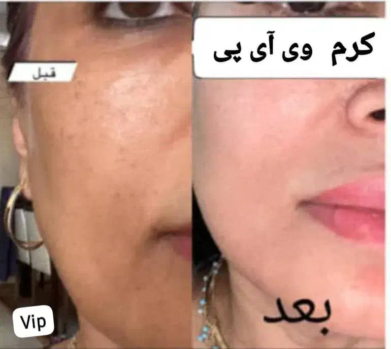 کرم vip تضمینی|آرایشی، بهداشتی، درمانی|رودان, |دیوار