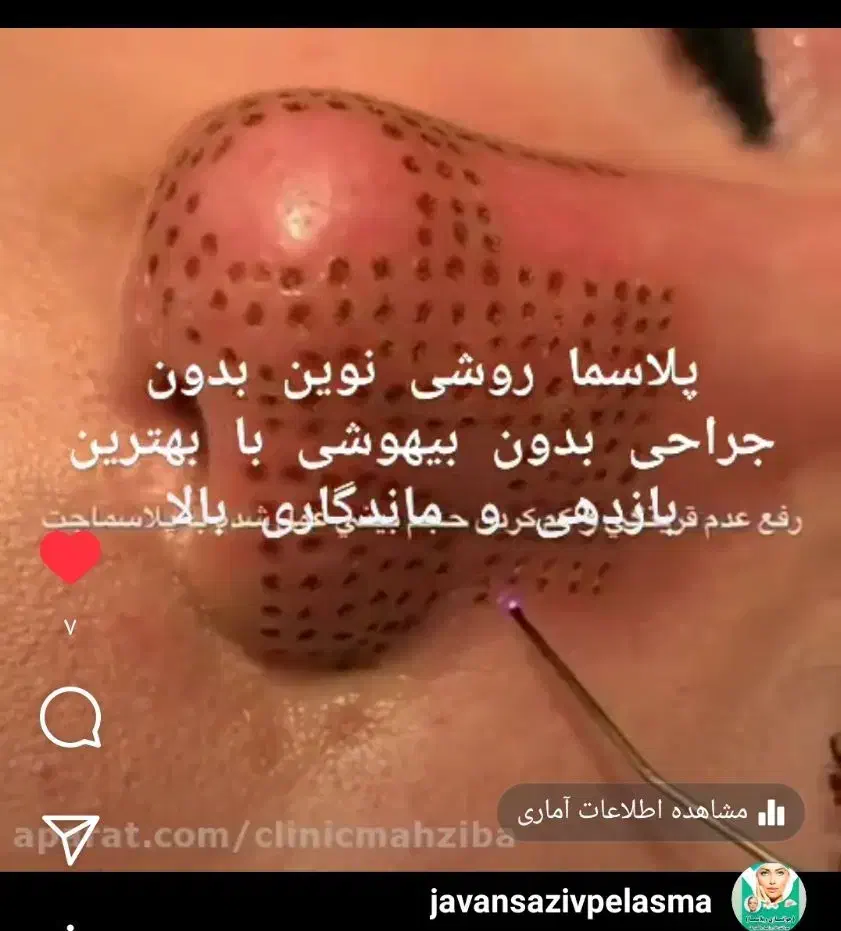 جوانسازی و پلاسماتراپی و مزونیدلینگ|خدمات آرایشگری و زیبایی|فرح آباد, |دیوار