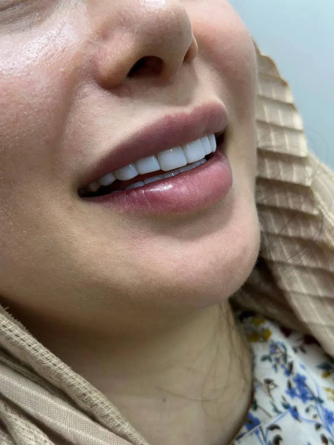 کامپوزیت دندان جشنواره|خدمات آرایشگری و زیبایی|تهران, فردوسی|دیوار