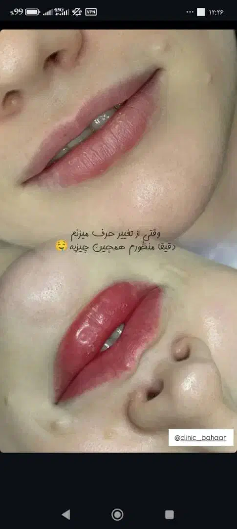 تزریقات ژل و بوتاکس و آنزیم|خدمات آرایشگری و زیبایی|اسلام‌شهر, شهرک مهدیه|دیوار