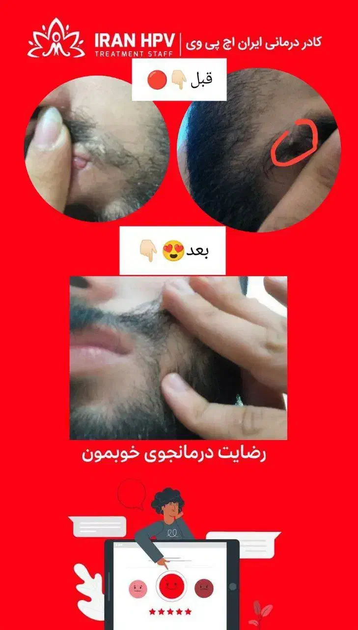 بهبود زگیل/تبخال/hpv/hsv|آرایشی، بهداشتی، درمانی|قم, یخچال قاضی|دیوار