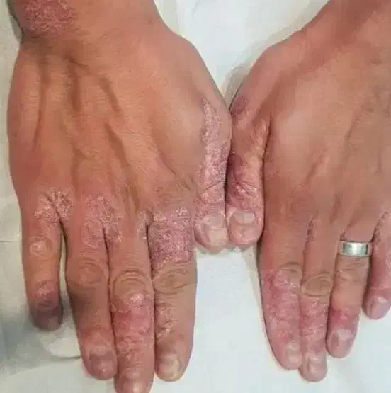 خودایمنی پسو|آرایشی، بهداشتی، درمانی|چالدران, |دیوار