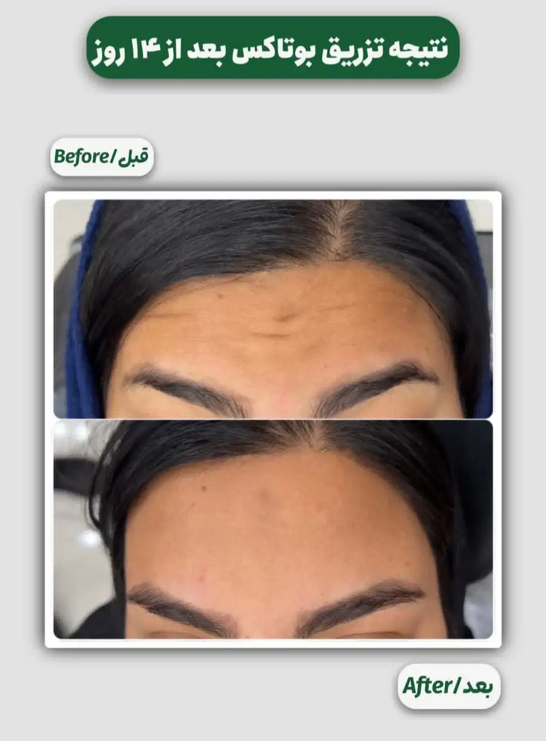 اف ویژه بوتاکس تعداد محدود|خدمات آرایشگری و زیبایی|یاسوج, |دیوار