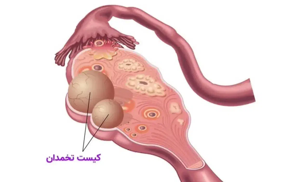 پاکسازی کامل مشکلات رحمی|خدمات آرایشگری و زیبایی|مهران (ایلام), |دیوار