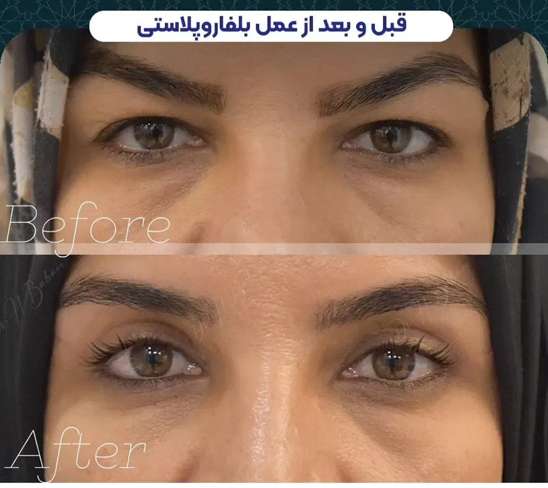 بلفاروپلاستی مدل بخیه لیزری،بوکال فت،ساکشن،سانترال|خدمات آرایشگری و زیبایی|تهران, هفت حوض|دیوار