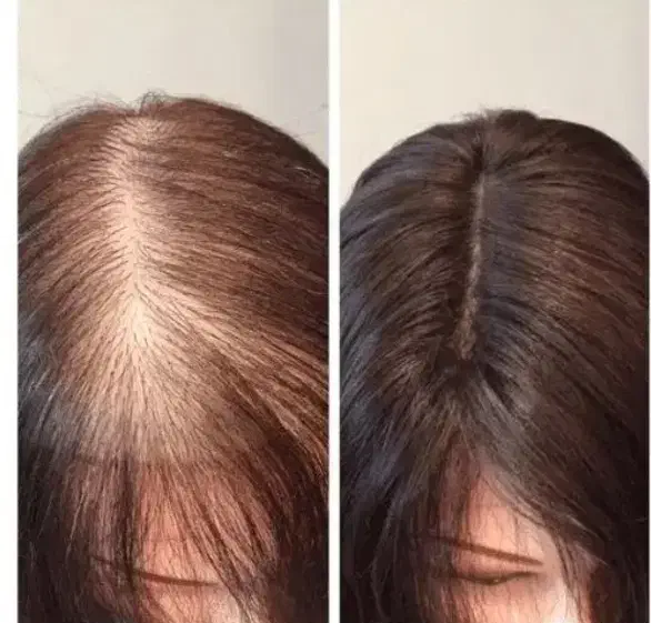 قطع ریزش مو و رشد مجدد|آرایشی، بهداشتی، درمانی|کرمان, |دیوار