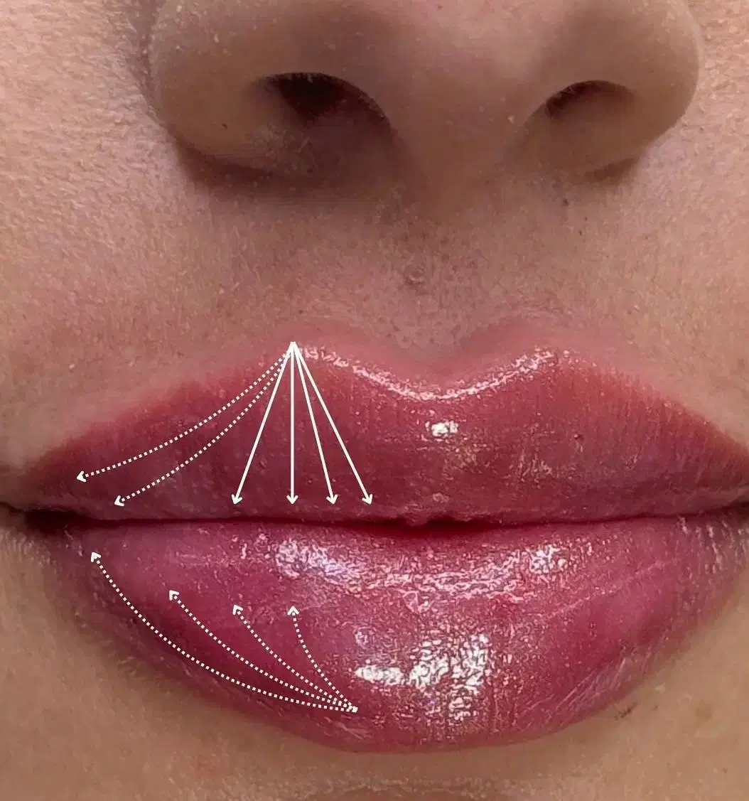 تزریق فیلر تخفیف هفتگی|خدمات آرایشگری و زیبایی|زابل, |دیوار