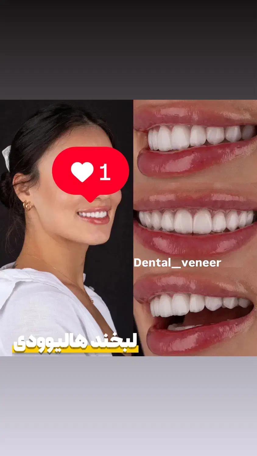 دندانپزشکی دنتال ونیر کامپوزیت لمینت ایمپلنت|خدمات آرایشگری و زیبایی|تهران, تجریش|دیوار