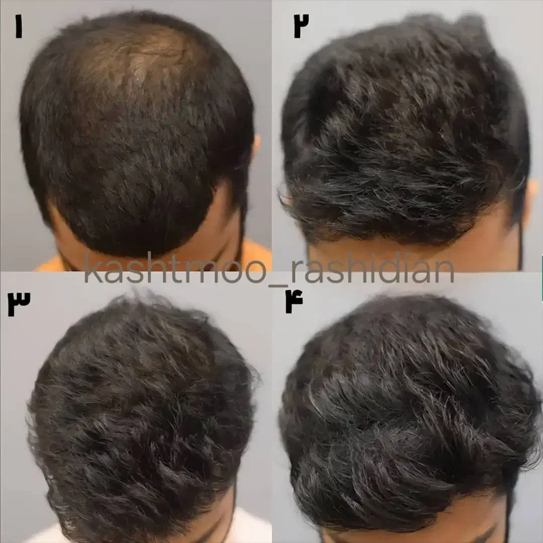 پی آر پی و مزوتراپی prp مو و ابرو|خدمات آرایشگری و زیبایی|اردبیل, |دیوار