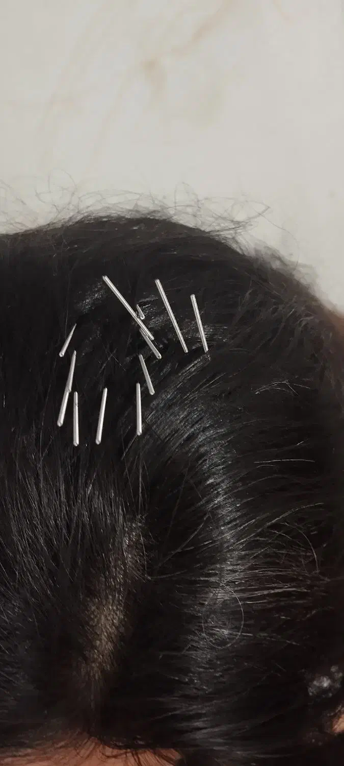 سوزن ، طب سوزنی ،|آرایشی، بهداشتی، درمانی|صائین قلعه, |دیوار