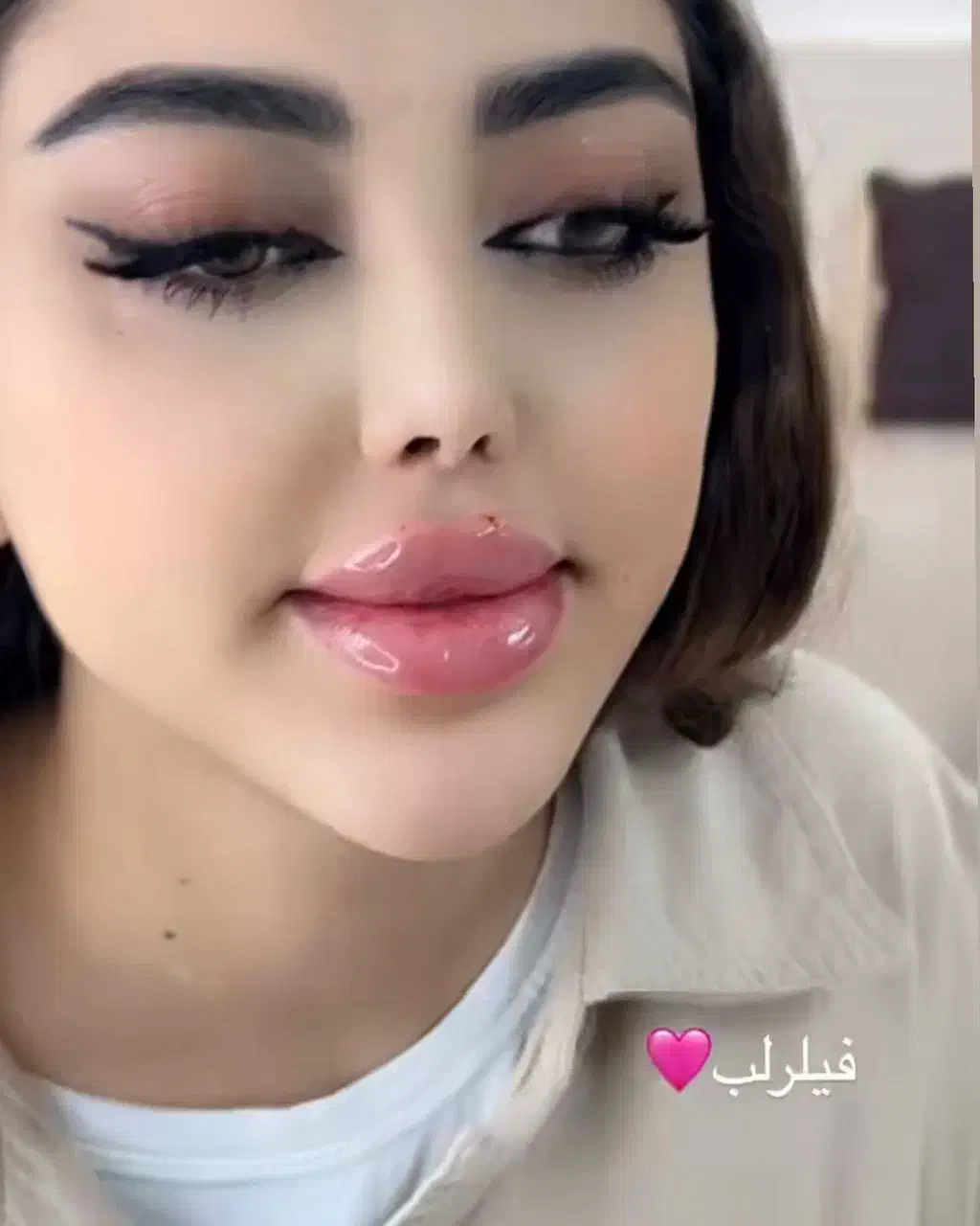 فیلر(ژل)و بوتاکس|خدمات آرایشگری و زیبایی|سهند, |دیوار