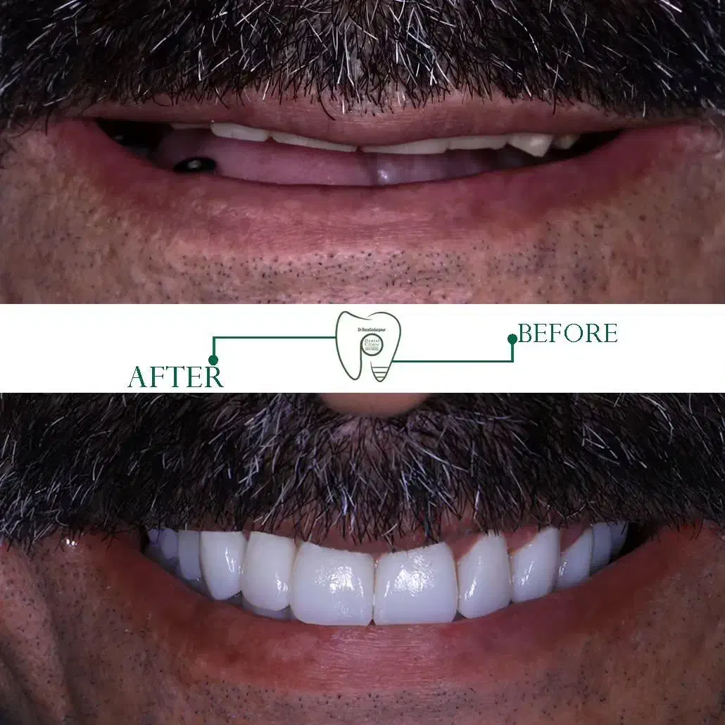 ایمپلنت دیجیتال اقساطی بدون سود تحت بیهوشی|خدمات آرایشگری و زیبایی|مرودشت, ژیان|دیوار