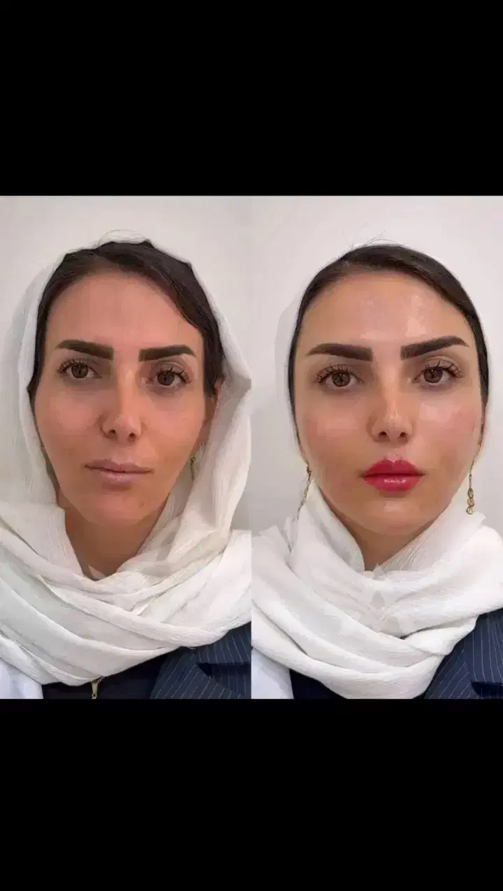 تزریق تخصصی فیلر، بوتاکس، ژل ، مطب زیبایی|خدمات زیبایی و سلامت|شیراز, سینما سعدی|دیوار