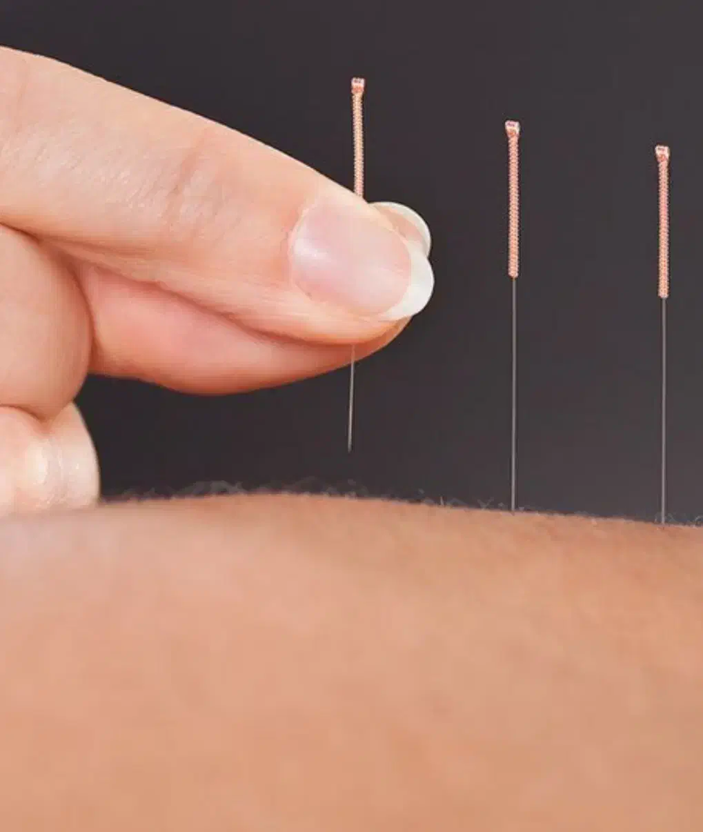 حجامت طبی سوزنی امبدینگ زالودرمانی زگیل تناسلیhpv|خدمات آرایشگری و زیبایی|اصفهان, بهارستان (مخابرات)|دیوار