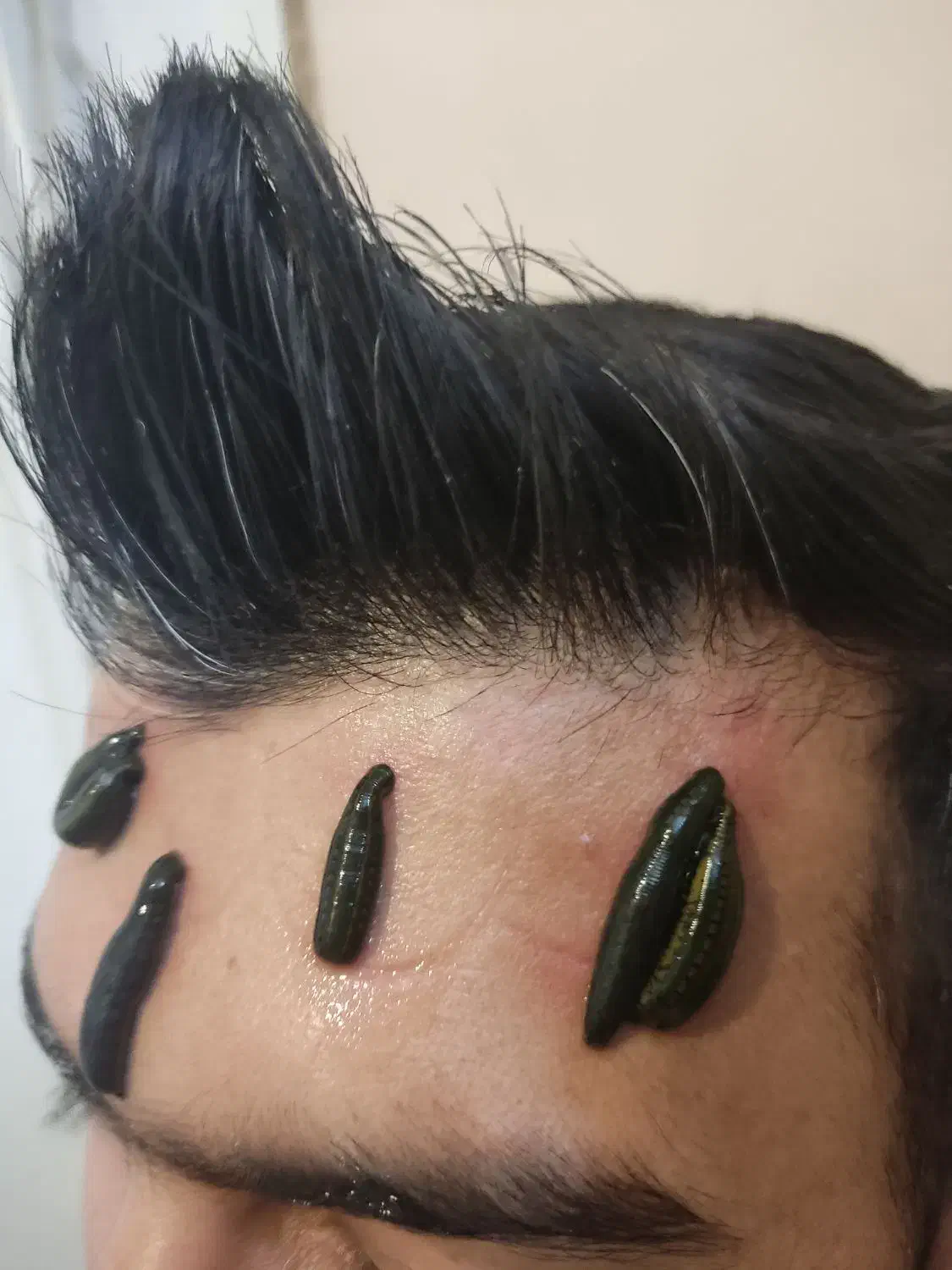 تخفیف۵۰٪ حجامت، فصد پیشانی، زالو، غلظت واریس دیسک|خدمات آرایشگری و زیبایی|اصفهان, برازنده|دیوار