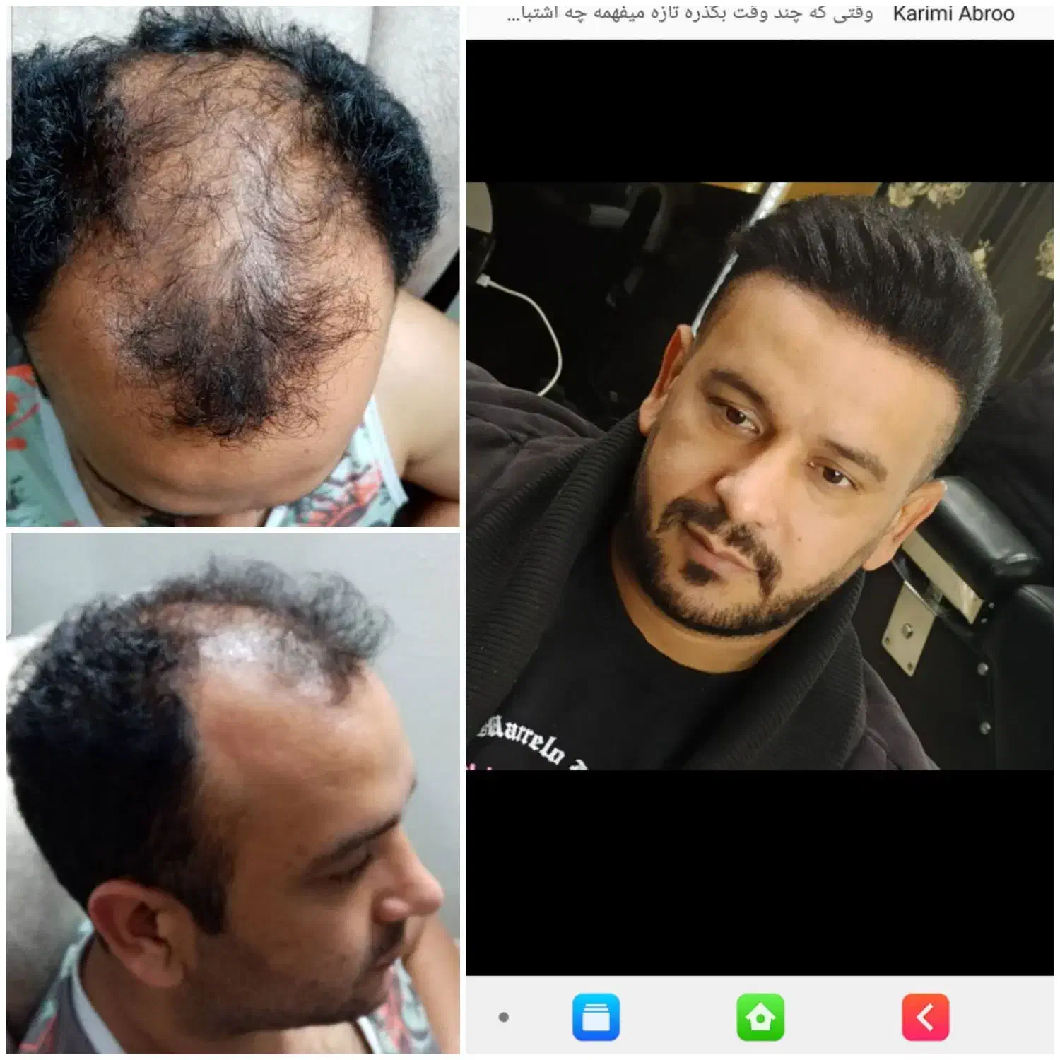 کاشت مو تضمینی واقساط|خدمات آرایشگری و زیبایی|اصفهان, محمودیه|دیوار