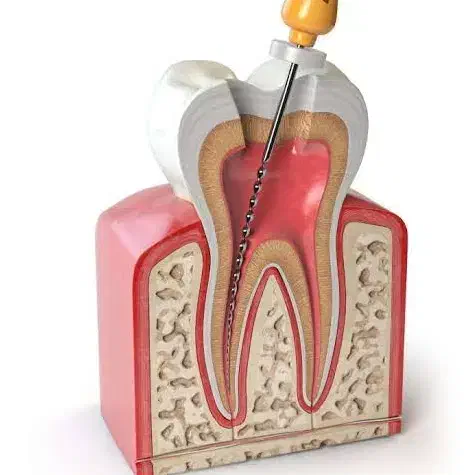 دندانپزشکی / عصب کشی دندان|خدمات آرایشگری و زیبایی|زاهدان, |دیوار