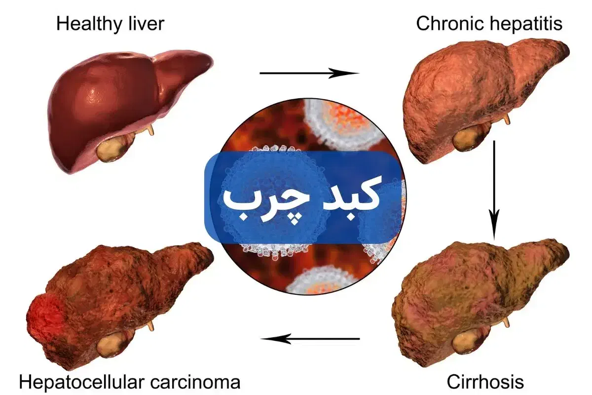 بهبود مشکلات کبدی|آرایشی، بهداشتی، درمانی|گنبد کاووس, |دیوار