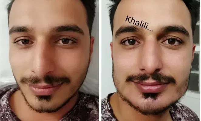 تزریق چربی ، فیلر بادی، ژل، بوتاکس در مطب|خدمات آرایشگری و زیبایی|شیراز, گویم|دیوار