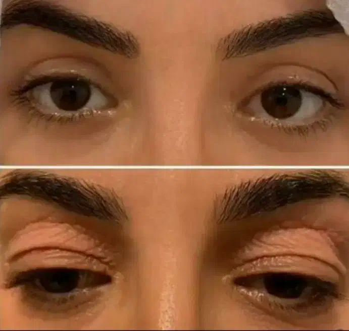 جراحی زیبائی پلک بالا|خدمات آرایشگری و زیبایی|گلپایگان, |دیوار