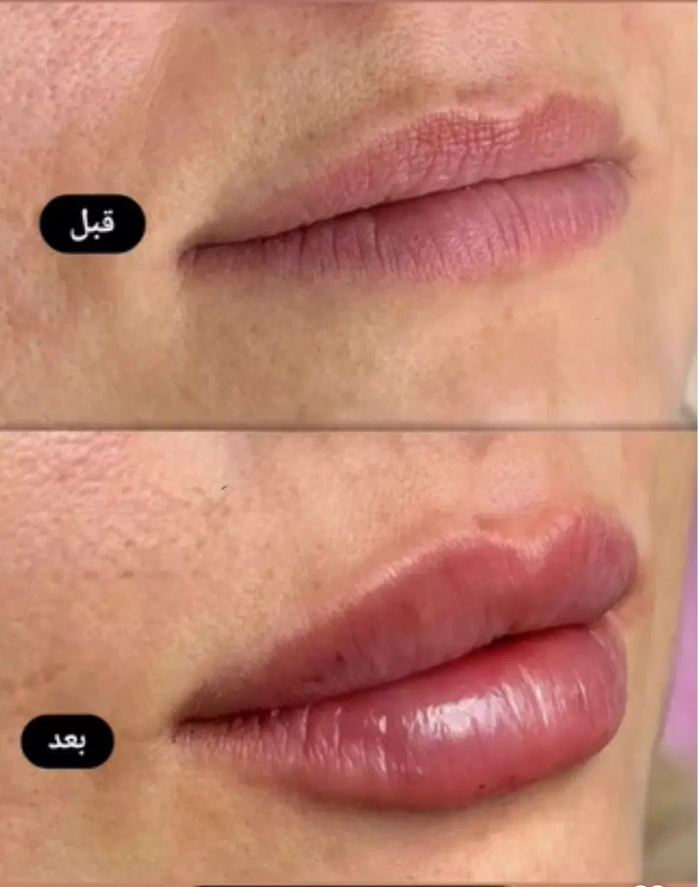 پی آرپی ۸۵۰بوتاکس ۸۵۰فیلر ۸۵۰|خدمات زیبایی و سلامت|کرمانشاه, |دیوار
