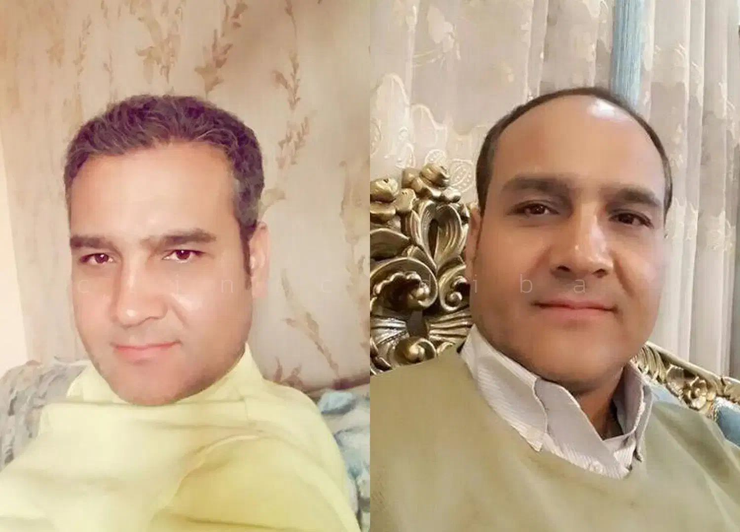 کاشت مو بدون درد و ورم (بدون تراشیدن مو)|خدمات آرایشگری و زیبایی|تهران, صادقیه|دیوار