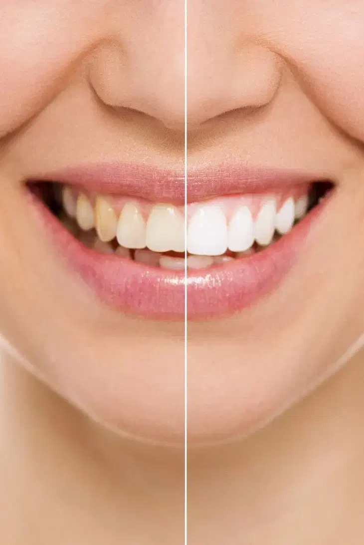 سفید کردن (bleaching) دندان در منزل|خدمات آرایشگری و زیبایی|گرگان, |دیوار