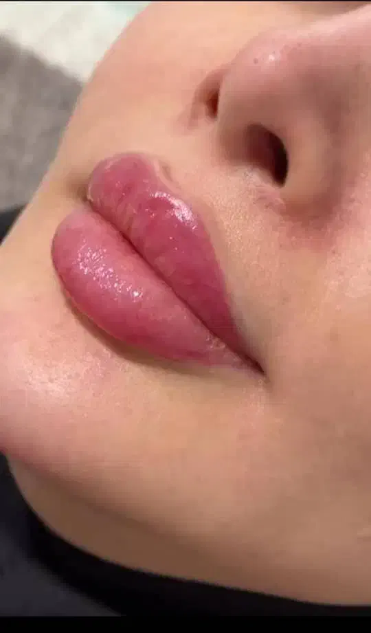 ژل و بوتاکس فیلر مزوژل مزو تخفیف 40 درصد|خدمات آرایشگری و زیبایی|مشهد, فلسطین|دیوار