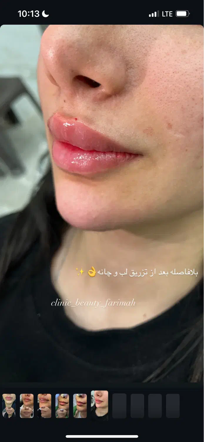 آف فیلر و بوتاکس فقطط۵۸۰|خدمات آرایشگری و زیبایی|ایذه, |دیوار