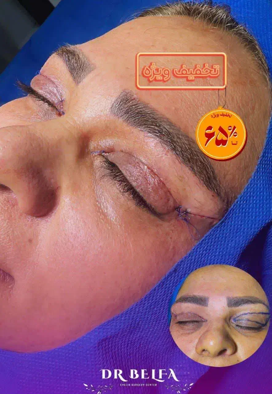 جشنواره ویژه بلفاروپلاستی(جراحی زیبایی پلک)|خدمات آرایشگری و زیبایی|بهبهان, |دیوار