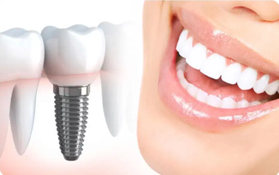 جشنواره ایمپلنت در عظیمیه کرج/فرصت محدود/ضمانتی|خدمات آرایشگری و زیبایی|هشتگرد, شهرک صنعتی هشتگرد|دیوار