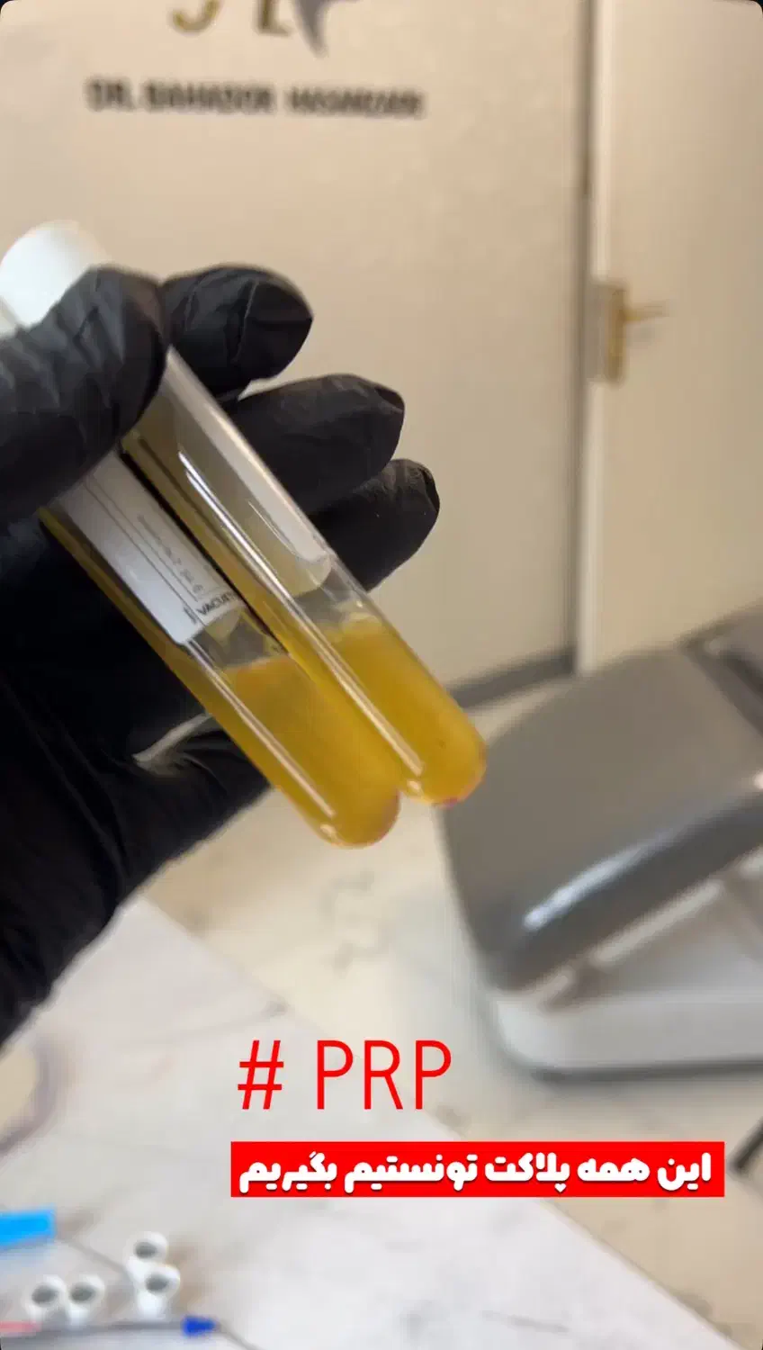 پی ار پی برای جوانسازی صورت، قطع ریزش مو، prp رشت|خدمات آرایشگری و زیبایی|رشت, گلسار|دیوار
