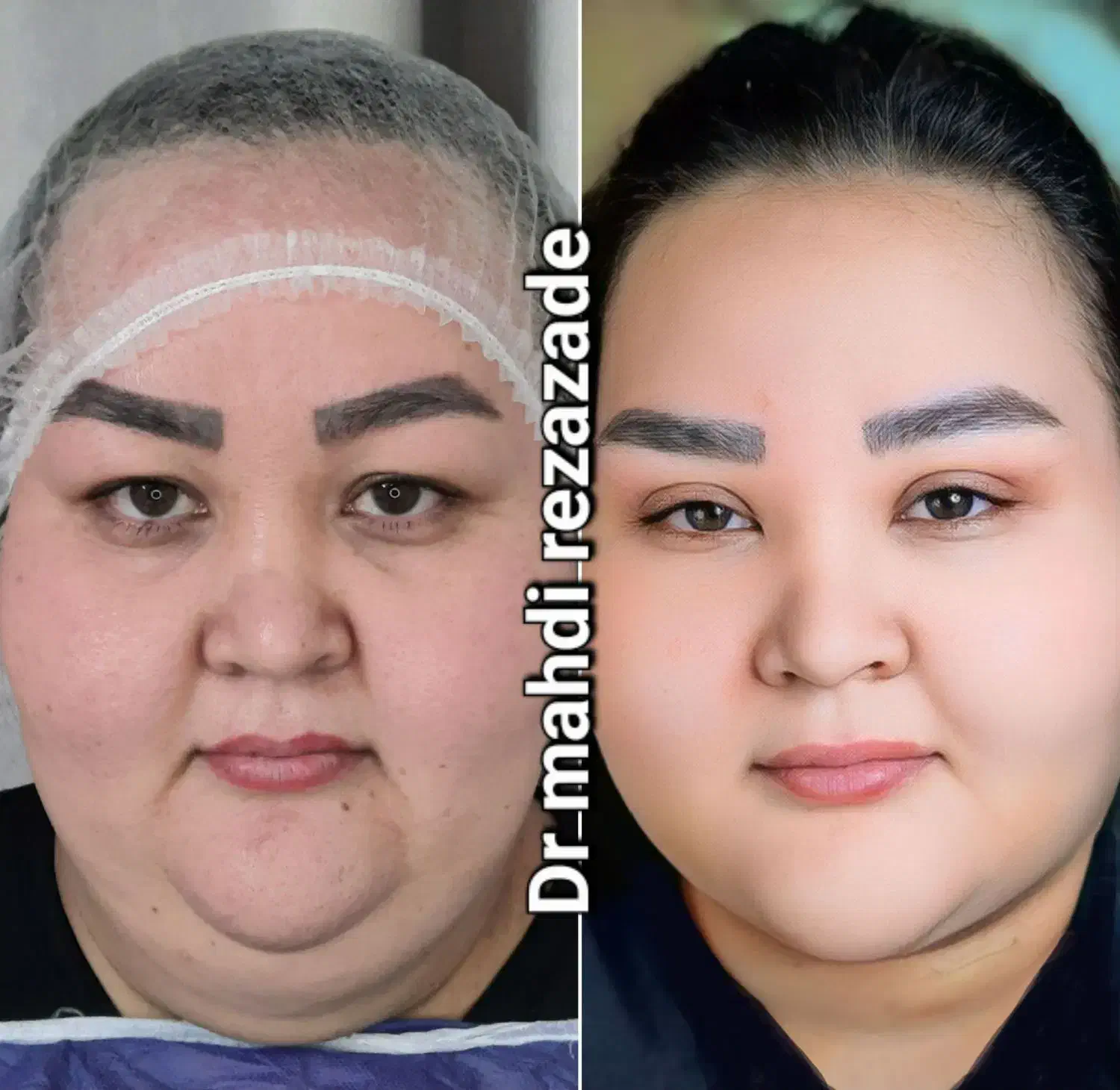 تخفیف ویژه، ساکشن تزریق چربی بلفارو کانتو اپیکانتو|خدمات آرایشگری و زیبایی|مشهد, هفت تیر (حافظ)|دیوار